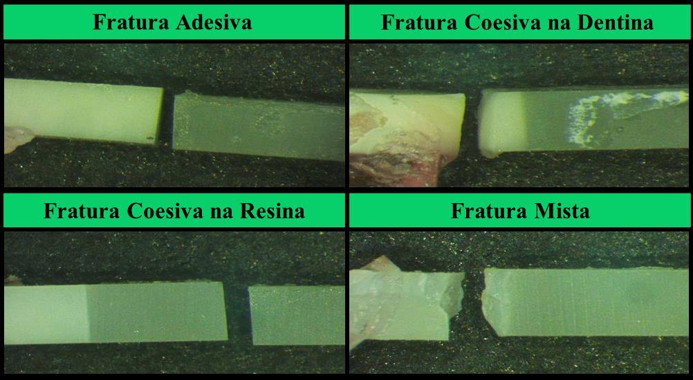 32 - Tipos de fratura observados, através da lupa estereoscópica