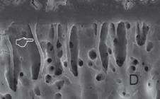 , 2014 as imagens obtidas por SEM (Microscopia Eletrónica de Varrimento) do adesivo Riva Bond LC revelam a formação de resin tags largas e cónicas, quando a dentina é pré-condicionada com ácido