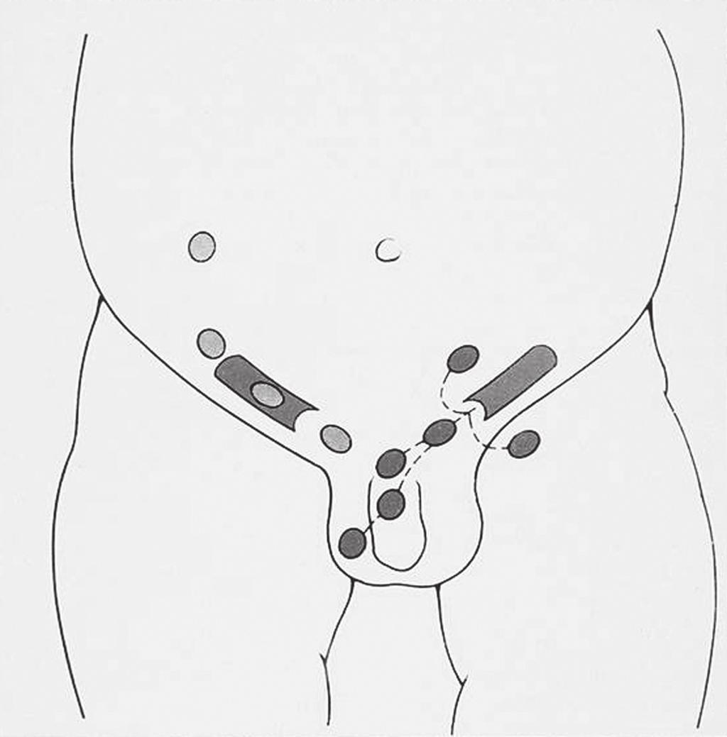 Criptorquia: benefícios da cirurgia precoce Rosito NC & Oliveira TLS Boletim Científico de Pediatria - Vol.