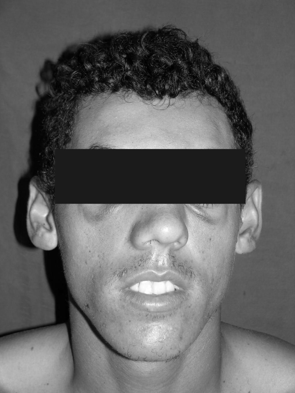 L CAVALIERI-PEREIRA et al. As fraturas do seio frontal são, às vezes, acompanhadas por fraturas de outros ossos faciais. Fraturas da maxila e do zigomático estão presentes em 25% dos casos 11.