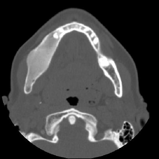 Displasia fibrosa do complexo craniofacial 60 Figura 5.