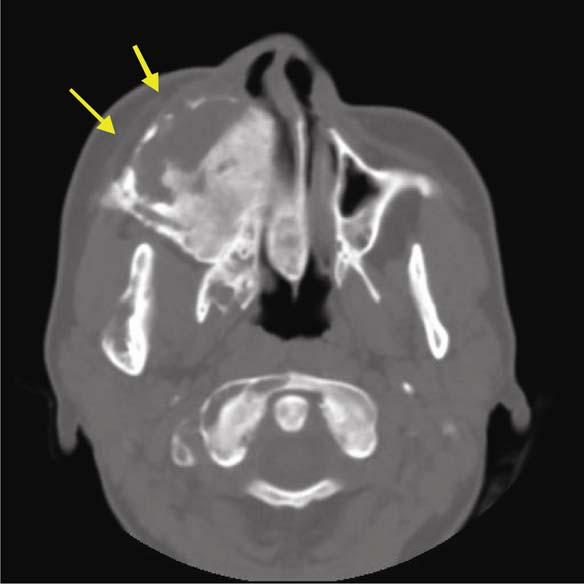 Displasia fibrosa do complexo craniofacial 61 Figura 5.