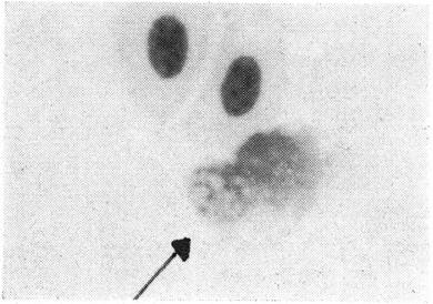 uma vez que constatamos também a presença de formas pigmentadas do Plasmodium (S.