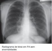 Figura 1 - Evolução espirométrica 23/01/08 05/12/08 23/09/09 05/03/10 Sem BD Sem BD Sem BD Pré-BD Pós-BD VEF 1 * 620 (21%) 570 (18%) 550 (19%) 660 (23%) 650 (22%) CVF * 1.