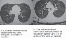 Os pacientes receptores de TMO se submetem à importante imunossupressão para que o transplante não seja rejeitado pelo sistema imunológico do hospedeiro.