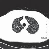 A B C D Fig.1. Cortes tomográficos evidenciam múltiplos cistos de formato irregular disseminados por ambos os pulmões.