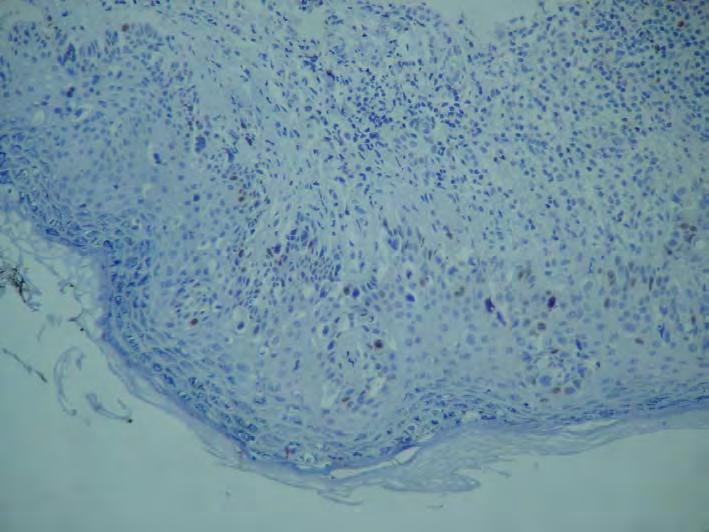 Técnica Imunoistoquímica 55 FIGURA 5- Fotomicrografia - preparação imunoistoquimica, com anticorpo anti receptor de estrógeno, mostrando reação