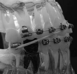 fazê-lo 8. A construção de um sistema de forças eficiente em Ortodontia tem por objetivo obter máxima movimentação dentária em menor tempo com a mínima geração de forças 1.