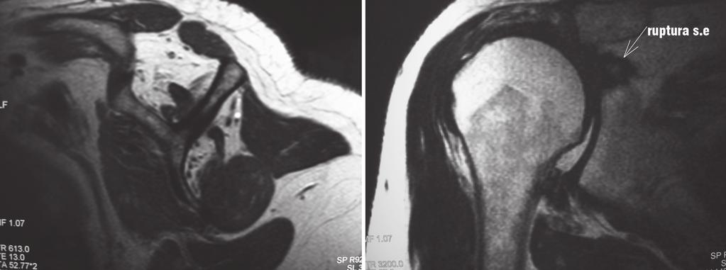 430 Figura 2 Corte sagital e coronal da ressonância magnética mostrando atrofia do SE com infiltração gordurosa, ruptura completa com retração no nível da glenoide e ascensão da cabeça umeral.