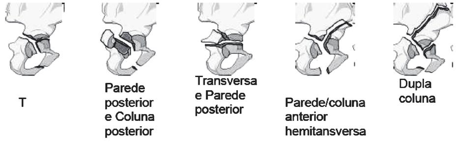 A classificação do grupo AO mantém o seu padrão de ser alfanumérica, onde a fratura do acetábulo é uma fratura do tipo 62 com seus modificadores A, B e C conforme aumenta a complexidade e piora o