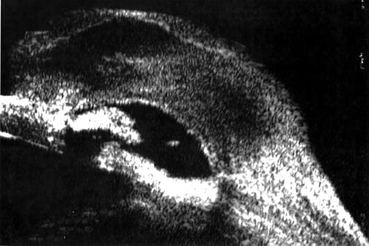 Fig. 3 - Imagem composta digitalmente de UBM do caso número 18. Bolha com mitomicina C com espessura da parede de 2,00 mm, e comunicação entre espaço subconjuntival e câmara anterior. Fig.