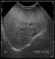 O diagnóstico da hepatopatia da fibrose cística Fagundes EDT et alii Jornal de Pediatria - Vol.