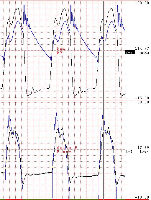 1 PAo PAo PV PV Fluxo Fluxo (a) (b) Figura 5. Registro dos sinais da Prótese Y-23, (a) = antes e (b) = após a liofilização, com frequência de 80 bpm e fluxo de 4,5 a 5,0 L/min.