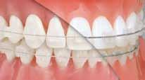 Caixas de ortodontia prata N-279 8,90 6,10 por 2 4,50 Caixas de ortodontia azul N-280 8,90 6,10 por 2 4,50 Caixas de ortodontia