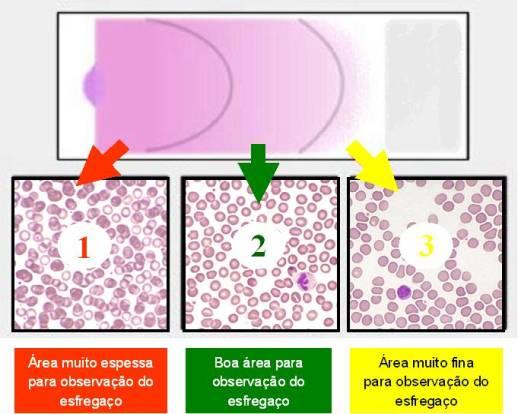 A vantagem de se fazer um hemograma é que algumas células podem ser contadas