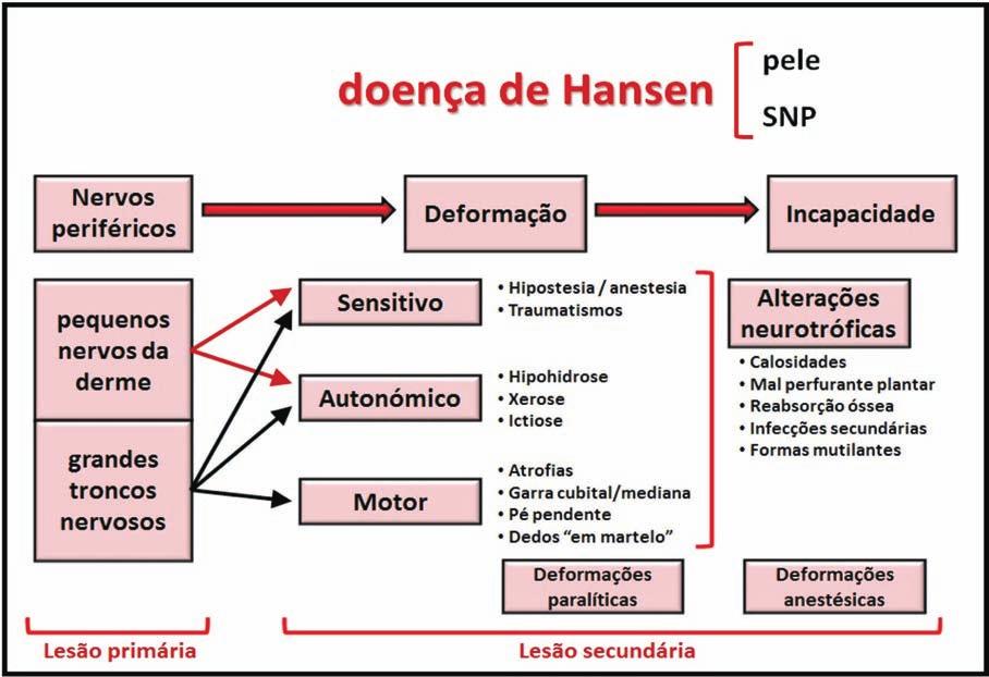 Fig 1 - Compromisso do Sistema Nervoso Periférico (SNP) na Doença de Hansen à doença de Hansen, suprimindo a monoterapia de longa duração com fármacos como a dapsona, mantendo a rifampicina em todos