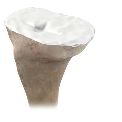 Quaisquer defeitos ósseos residuais da pequena cavidade devem ser embalados com auto-enxerto esponjoso, aloenxerto ou substituto ósseo