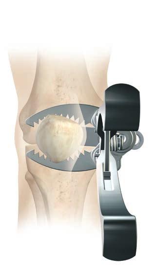 APÊNDICE A: PREPARAÇÃO E IMPLANTAÇÃO DA RÓTULA 25 mm Figura 51 Posterior Anterior Estilete da rótula 8,5 mm 16,5 mm Exemplo (para uma rótula em cúpula ou oval/em cúpula de 38 mm): A partir de uma