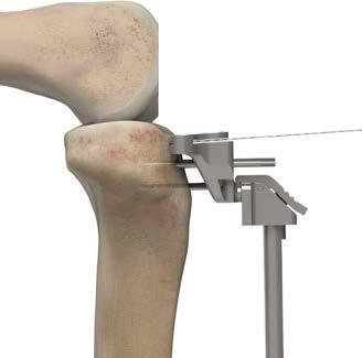 da chanfradura femoral Passo 10: Redução de teste