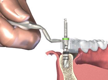 Passo 5 Alargue o local de implantação até ao Ø 4,2 mm Termine a preparação básica do local de implantação com a broca helicoidal PRO de Ø 4,2 mm para cirurgia guiada.