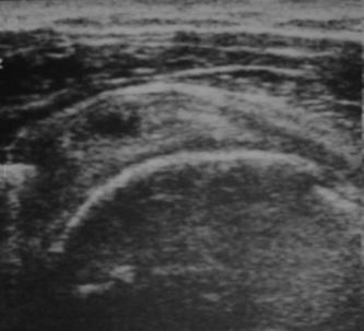 Supraespinal: Corte longitudinal do tendão do m. supraespinal apresentando área circular hipoecogênica no interior do tendão, compatível com ruptura parcial das fibras.