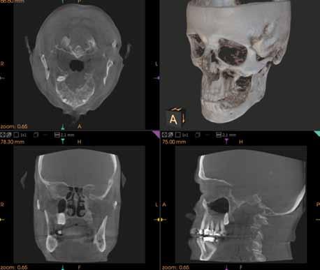 CBCT CBCT apareceu na Europa em 1999 e só mais tarde, em 2001, nos EUA. Ao contrário dos sistemas tradicionais, usa um feixe cónico de raio-x para a obtenção das imagens.