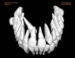 3). Com esta tecnologia prescinde-se das impressões iniciais dos pacientes, dado que temos a informação completa dos dentes e