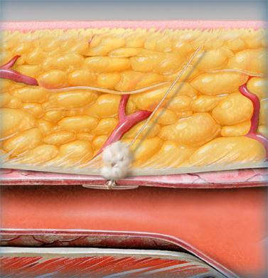 AÇÃO HEMOSTÁTICA Primária: Mecânica Âncora + Arteriotomia +