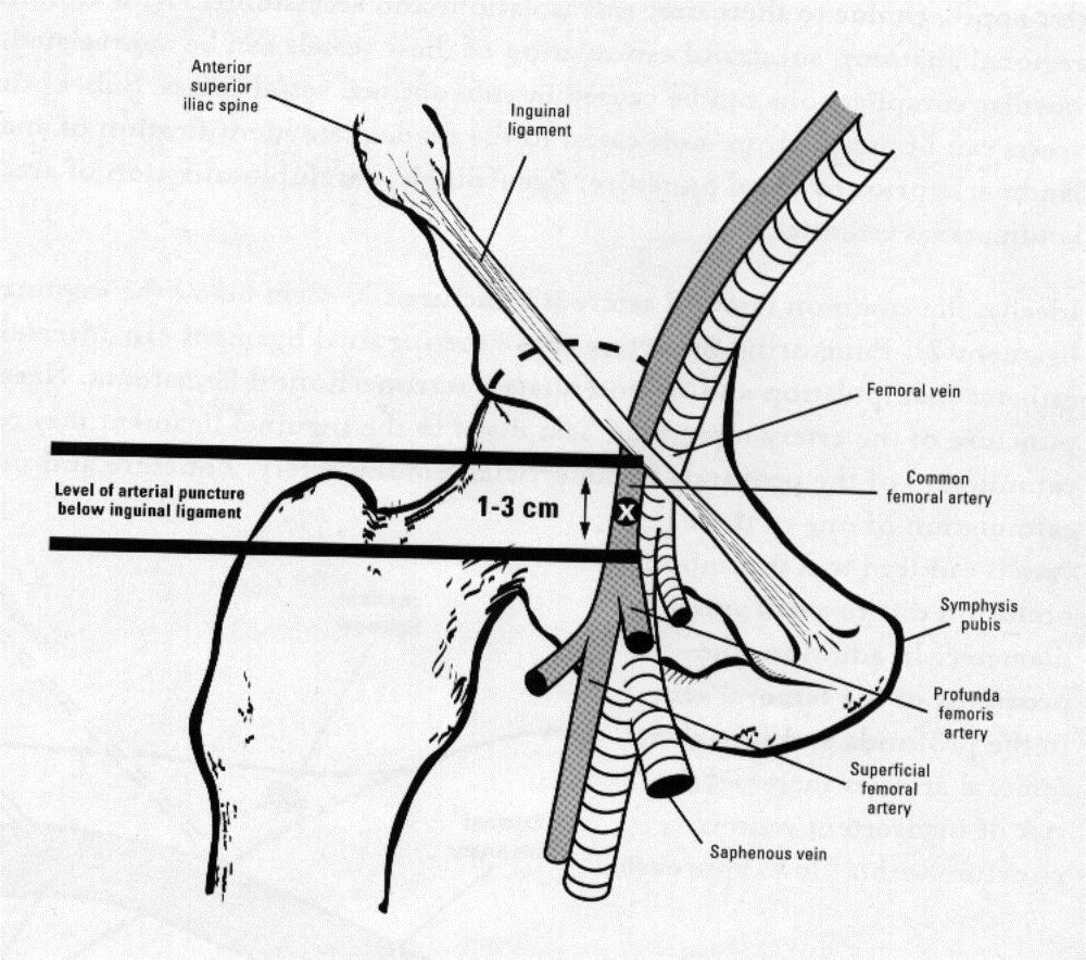 CHAVES PARA ACESSO FEMORAL BEM-SUCEDIDO Punção 1 3 cm abaixo do ligamento