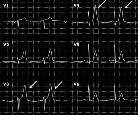 Tamponamento cardíaco Baixa amplitude elétrica Alternância elétrica