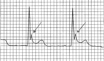 curto < 320ms Hipocalcemia: QT longo Digoxina: Bradicardia sinusal com