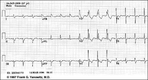 3 Bloqueios de Ramo QRS > 120ms Direito Padrão de rsr em V1 - uma onda positiva seguida de uma negativa e depois uma positiva de novo, sendo esta última de maior amplitude Derivações avr, V1, V2 e