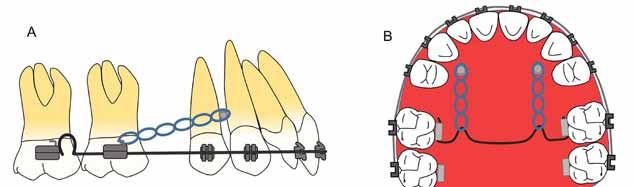 Mecânicas de mesialização utilizando ancoragem esquelética Figura 3 A - Aplicação da força entre o mini-implante e o sliding-jig cria um binário no arco, causando um tip-back de molar.