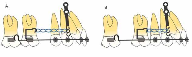 Stangler, L., Menezes, L.M., Lima, E.M. Figura 5 A - Ativação da mecânica com a colocação de elástico em cadeia diretamente entre a miniplaca e o dente.