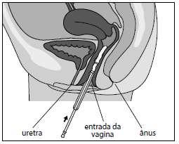 Desapertar o êmbolo do aplicador, para que o tubo do aplicador deslize Segurar a bisnaga com a abertura voltada para cima; prender o aplicador na abertura da bisnaga Encher o tubo do aplicador até