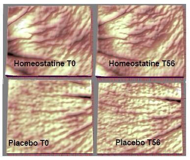 Figura 4. Reconstituição topográfica da evolução das rugas com Homeostatine versus placebo. T T56 Figura 5.