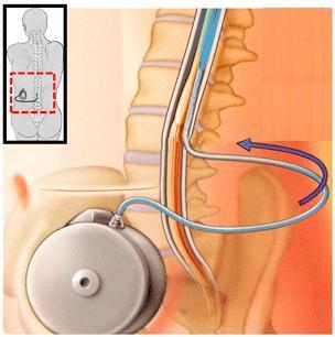 6-Tratamento do paralisia cerebral-bomba de Baclofeno