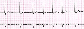 b) Bloqueio aurículo-ventricular completo c) Bradicardia sinusal d) Enfarte Agudo do Miocárdio 6. Qual o diagnóstico ECG do traçado abaixo?