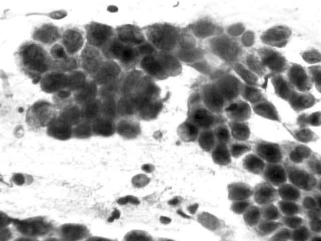 endocervical Figura 5 Campo de células de origem indiferenciada com hipercromasia nuclear e pleomorfismo Figura