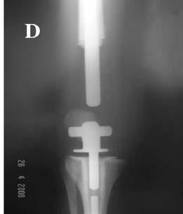 A) Radiografia simples do fêmur; B) Ressonância magnética da região afetada; C) Peça ressecada e endoprótese parcial distal do fêmur; D) Radiografia simples pós-operatória, mostrando a reconstrução.