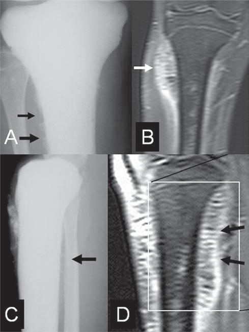 A: Reação periosteal multilamelar (seta branca), em casca de cebola, identificada pela radiografia simples na diáfise do úmero em uma criança com cerca de 1 ano e 8 meses com osteomielite crônica