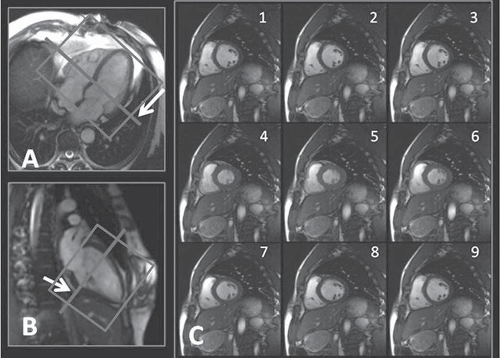 Avaliação da função ventricular pela RM sem apneia e com 3 NEX Figura 1. A,B: Programação dos cortes, no eixo curto do VE, ortogonais ao septo.