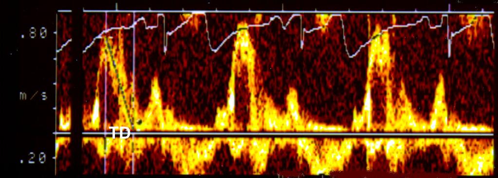 4 Revisão da Literatura 28 seja, quando a pressão atrial esquerda se eleva o pico da onda E aumenta e o TD diminui.