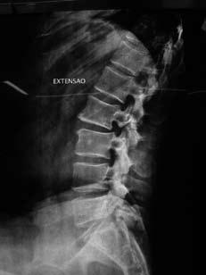 Artrodese minimamente invasiva para espondilolisteses de baixo grau Figura 1 Paciente portador de EPL lítica L2-L3 e L5-S1 falha do tratamento conservador.