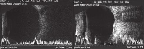 A ultra-sonografia oftalmológica convencional no modo B é geralmente realizada com sondas de 8 e 10 MHz para estudo das anormalidades do segmento posterior, enquanto transdutores de alta freqüência