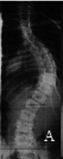 Deino HLA, Scarparo P Figura Paciente do Quadro : radiograias pré-operatórias (A e B), pós-operatório imediato (C e D) e com cinco