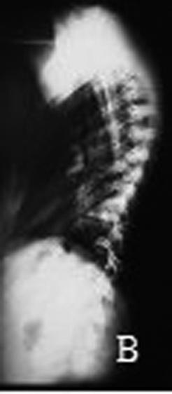 cinco anos de seguimento (E e F) DISCUSSÃO O tratamento cirúrgico das deormidades da coluna vertebral tem sorido alterações