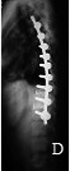 vertebral associada à estabilidade do tronco, devendo a correção da deormidade ser realizada de modo tridimensional.