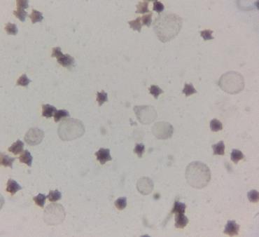 mieloblastos e monoblastos, através de coloração citoquímica complementar (Sudan Black B. Objetiva de 100X em imersão).