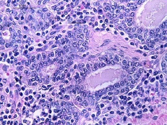 Ácinos atróficos e células inflamatórias intersticiais esparsas. C) PIA moderada. Atrofia acinar e agregados de células mononucleares. D) PIA acentuada.